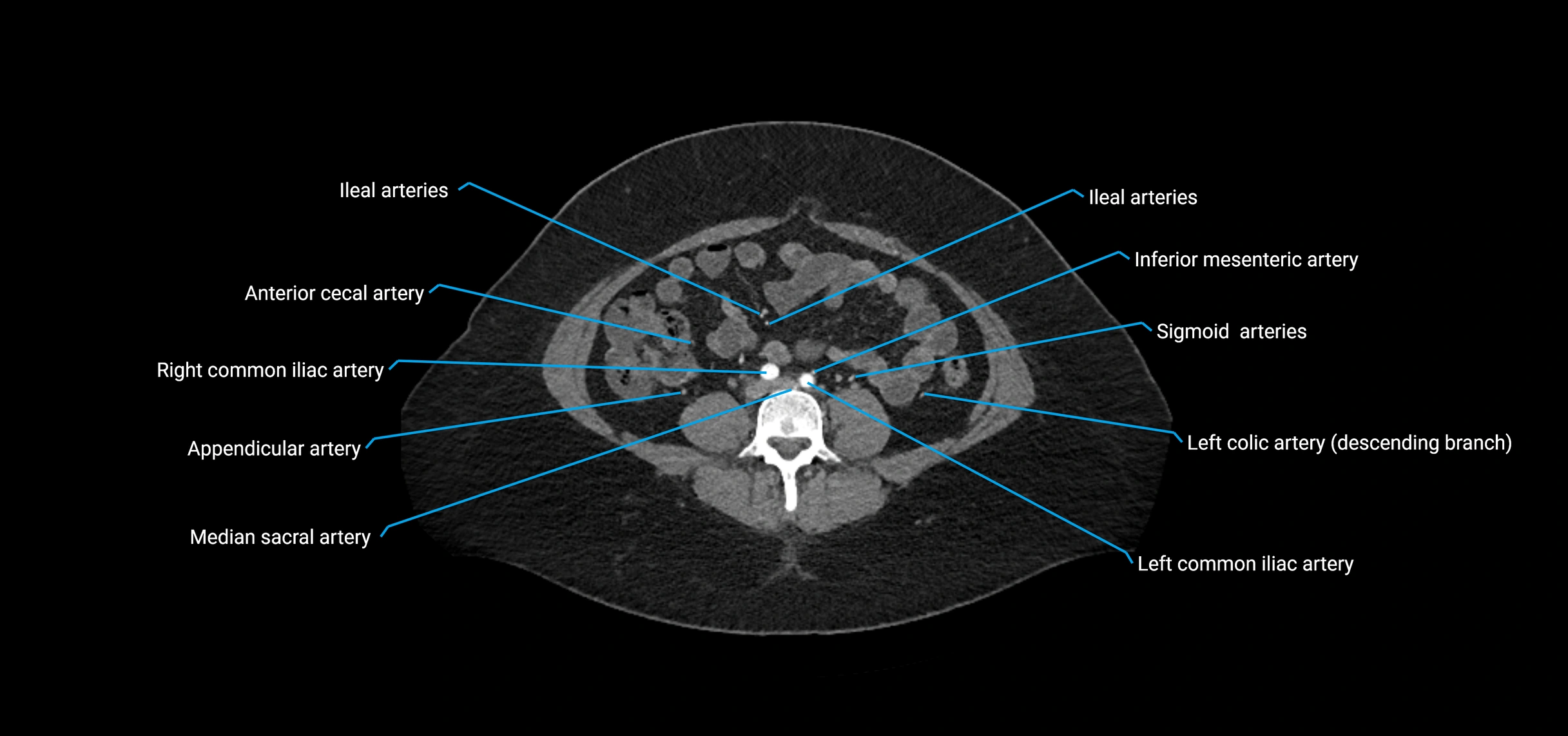 CTA abdomen axial cross sectional anatomy labelled image_142 (2).webp